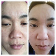 Facial-Mesotherapy-Effects