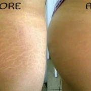 how-to-hide-your-stretch-marks-with-02